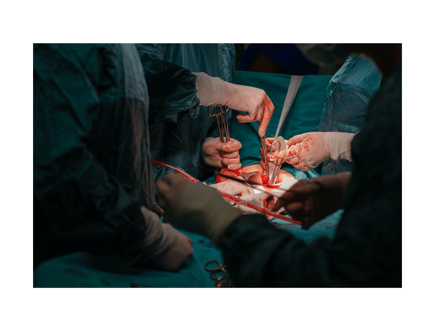 close up of surgery in progress showing medical instruments and surgical team